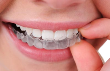 Braces Orthodontic Treatment