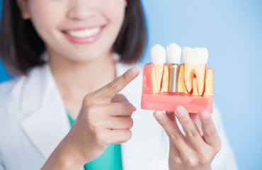 Dental Implants